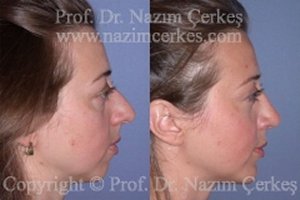 Rhinoplasty Nose Aesthetics+Chin Implants Before After Pictures