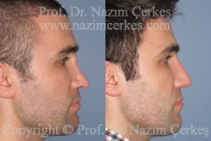 Revision Nose Surgery Rhinoplasty Before After Pictures Male