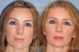 Revision Nose Surgery Rhinoplasty Before After Pictures Female