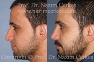 Nose Surgery Rhinoplasty Before After Pictures Male