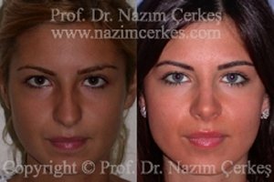 Nose Surgery Rhinoplasty Before After Pictures Female