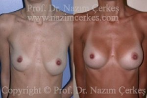 Breast Augmentation Before After Pictures
