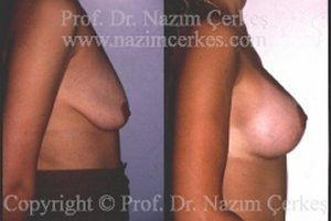 Breast Lift Before After Pictures