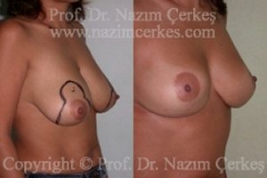 Breast Reduction Before After Pictures