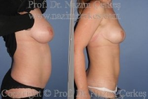 Breast Aesthetics & Tummytuck Before After Pictures