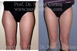 Liposuction Before After Pictures