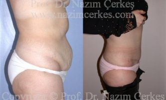 Tummy Tuck Abdominoplasty Before After Pictures